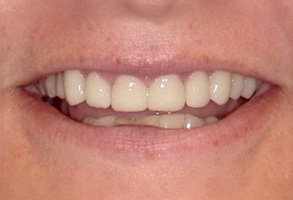 Isbell Dental | Root Canals, Invisalign reg  and Dental Fillings