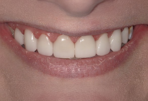 Isbell Dental | CBCT, Preventative Program and Extractions