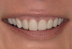 Isbell Dental | Extractions, Suresmile reg  and Dental Sealants