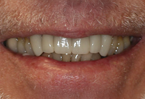 Isbell Dental | CEREC, Preventative Program and Invisalign reg 