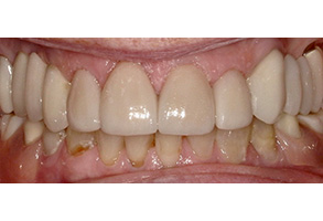 Isbell Dental | Digital Impressions, Dental Bridges and Periodontal Treatment