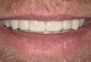 Isbell Dental | Botox®, CBCT and Digital Impressions