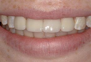 Isbell Dental | CEREC, Implant Dentistry and Dentures