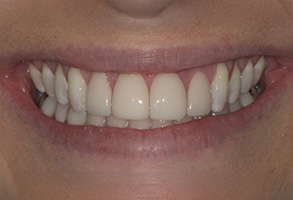 Isbell Dental | Implant Dentistry, Extractions and Periodontal Treatment