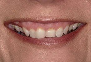 Isbell Dental | Teeth Whitening, Ceramic Crowns and Digital Impressions