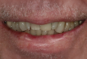 Isbell Dental | Sports Mouthguards, CEREC and 3-D Printer