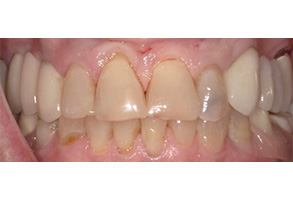 Isbell Dental | Dental Bridges, Suresmile reg  and Botox reg 