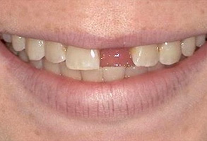 Isbell Dental | Candid, Botox® and Dental Bridges