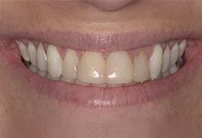 Isbell Dental | Digital Impressions, Cosmetic Dentistry and Suresmile®